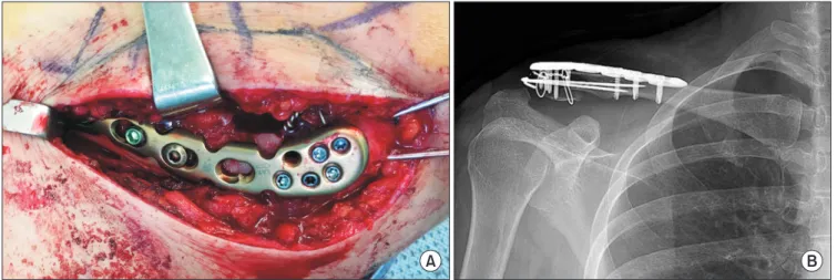 Fig. 2. (A) Final application and fixation of the anatomical locking plate. (B) Immediate postoperative radiograph showed appropriate reduction of fracture with  adequate distal screw and K-wire fixation.