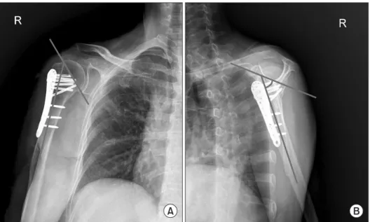 Fig. 2. (A) a angle: angle created at the  intersection of a line through the anatomic  neck and a line parallel to the proximal  hu-meral shaft