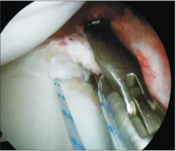 Fig. 4. Length of the hook part of each type are variable and screw movement  can make it difficult to estimate the exit of the instrument during the passing  procedure.