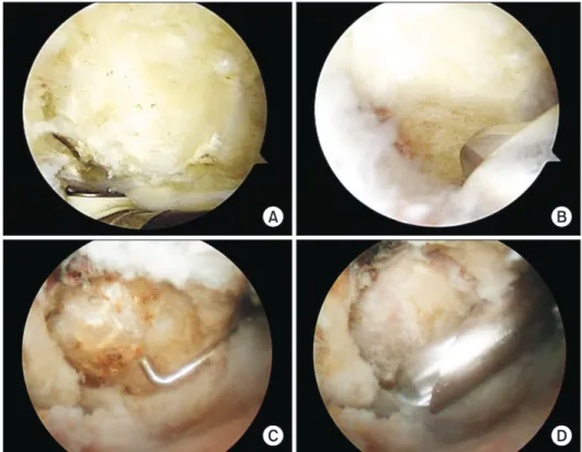 Fig. 1. Arthroscopic view of coracoid pro- pro-cess by subacromial approach from the  lat-eral portal (A) and coracoplasty performed  by resection of the undersurface of the  coracoid (B)