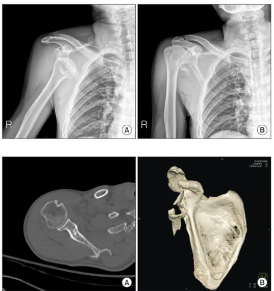 Fig. 2. (A) Axial view of computed tomog- tomog-raphy shows concentric reduction of the  glenohumeral joint of the right shoulder