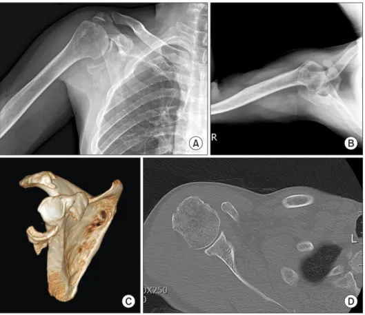 Fig. 6. Postoperative 1-year follow-up x-ray  anteroposterior (A), axial (B) and  3-dimen-sional computed tomography image (C),  axial scan (D) shows no interval change of  inferior fragment without arthritis.