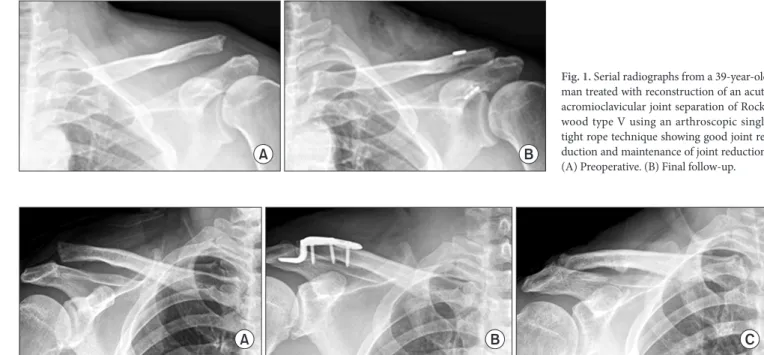 Fig. 1. Serial radiographs from a 39-year-old  man treated with reconstruction of an acute  acromioclavicular joint separation of  Rock-wood type V using an arthroscopic single  tight rope technique showing good joint  re-duction and maintenance of joint r