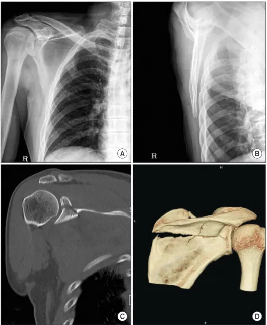 Fig. 1. (A, B) Simple radiologic evaluation  showed an Ideberg classification type V  glenoid fracture with scapular extension  in 68-year-old man
