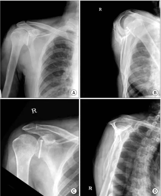 Fig. 3. (A, B) Postoperative radiologic image  of the right shoulder. (C, D) After 16 weeks  later, bone union was confirmed.