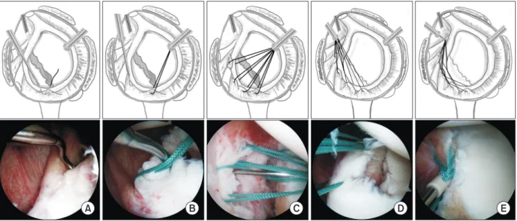 Fig. 1. Description of the multiple pulled suture technique. (A) The suture hook load with a shuttle-relay penetrates the torn labroligamentous complex associ- associ-ated with an anterior glenoid rim fracture