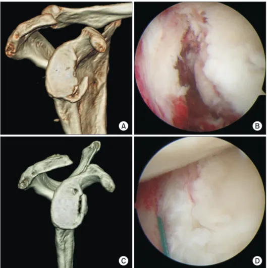 Fig. 4. Case 3. (A) Preoperative computed  tomography (CT) scan shows glenoid bone  loss of 25%, and a comminuted and shallow  bony fragment