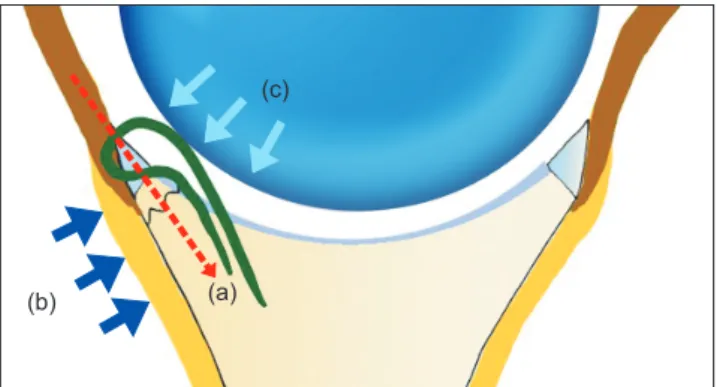 Fig. 5. Theoretical basis for the multiple pulled suture technique. (a) The  fracture site is compressed by the coupled forces (vector) of the pulled sutures  and the reaction