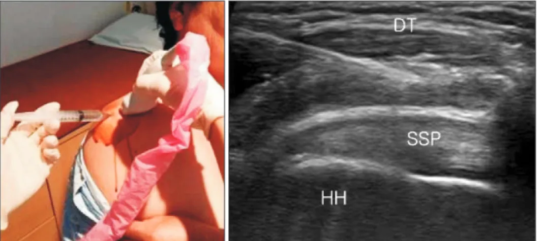 Fig. 1. Ultrasound Guided Impingement  Test. 