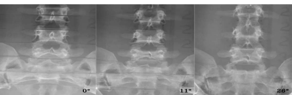 그림  5.  L4,  L5  ap  X-ray  applied  to  incidence  angle Ⅳ.  고찰 척추질환은  고령화에  따른  노인  인구의  증가,  비만,  잘못된 생활습관, 골다공증 등으로 인해 늘어나고 있으 며 허리뼈가 90%를 차지한다