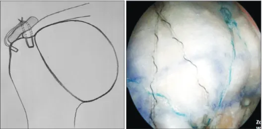 Fig. 2. Patch augmentations can decrease  the initial high tension applied to repair sites  in massive rotator cuff tears.