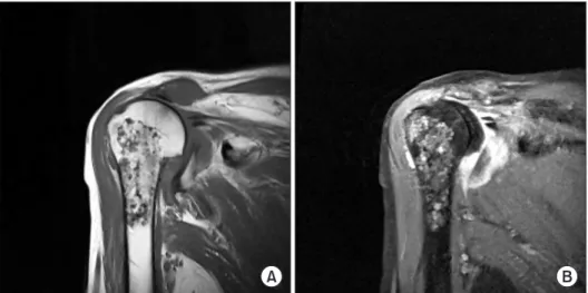 Fig. 4. Intraoperative image of the proximal humerus enchondroma after re- re-section of the humeral head (arrow).