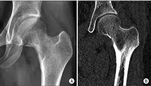 Fig. 3. Postoperative pelvic anteropos- anteropos-terior radiograph (A) and postoperative  computed tomography scan (B) show a  completely excised lesion and removed  bony protrusions.