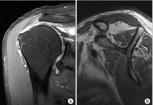 Fig. 1. A 56-year-old man with large  rotator cuff tear of right shoulder and  substantial fatty muscle degeneration