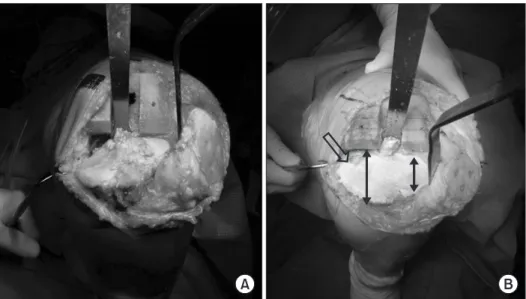 Fig. 2. Anatomical distortion of proximal  tibia after closed wedge high tibial  oste-otomy (HTO) and prepared surface of the  tibia