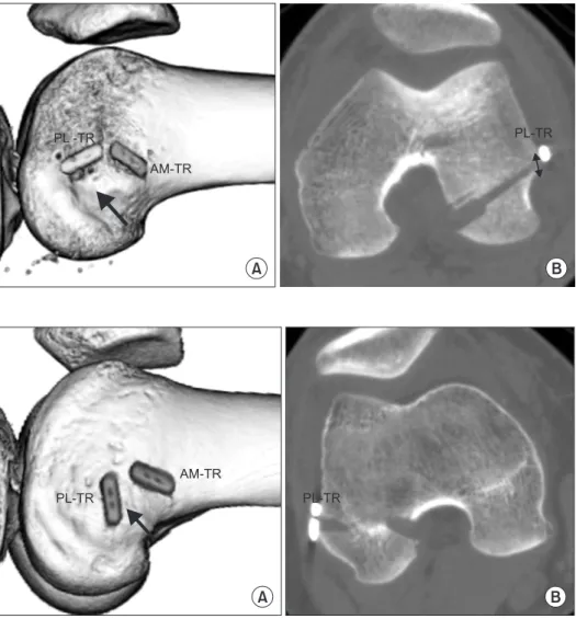 Fig. 2. Computed tomography images  of case 2. (A) View of the lateral femur  showing the TightRope (TR) button of the  posterolateral (PL) bundle placed near the  lateral epicondyle