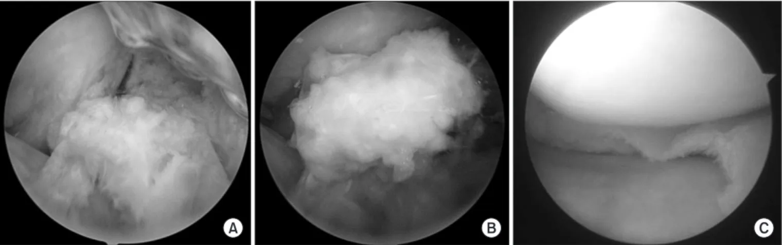 Fig. 3. (A) Arthroscopic view showing a whitish, ovoid-shaped loose body buried in the infrapatellar fat pad
