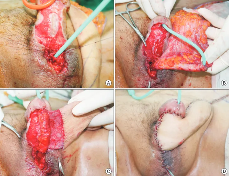Fig. 3. Anastomosis of neourethra to the normal membranous urethra (A, B) and glans base (C)