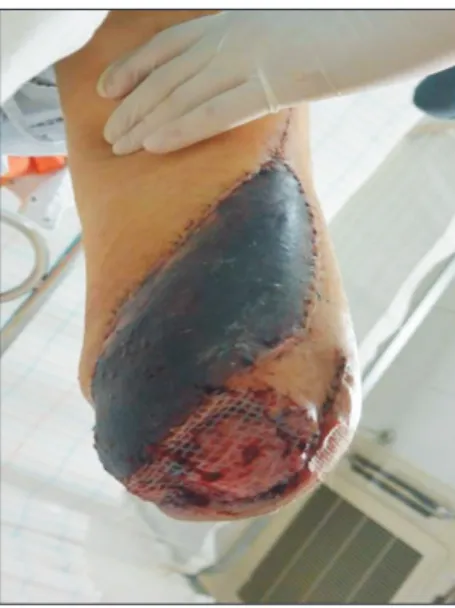Fig. 3. Status of the stump on day 2 after a pedicled anterolateral thigh  flap and meshed split thickness skin graft were used.