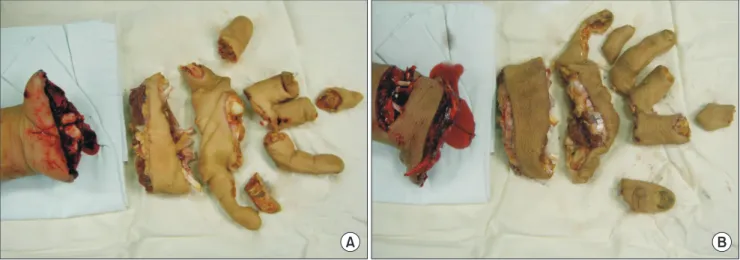 Fig. 1. A 39-year-old man working on a farm presented six hours after an accident while using a straw cutter causing multi-segment amputation,  involving the whole palm and digits