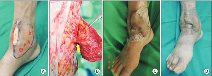 Fig. 1. A case of anterior ankle defect. (A) Ankle defect with exposure of extensor hallucis longus tendon