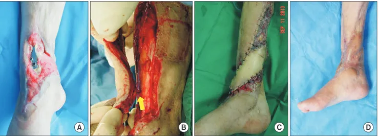 Fig. 3. Ankle defect with metal fixator exposure. (A) Ankle defect with exposure of the metal fixator