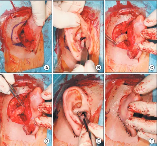 Fig. 1. Flap design, elevation and insetting. (A) Posterior auricular artery was marked by Handheld Doppler tracing on the retroauricular region