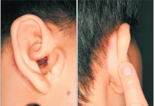 Fig. 3. Flap design, elevation and insetting. (A) The flap was designed on the retroauricular skin, considered to size of external ear defect