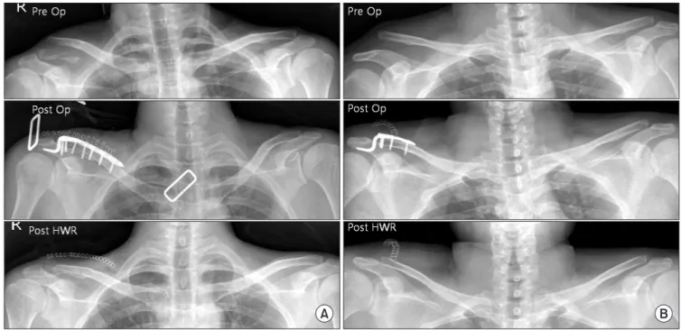 Fig. 4. (A) The radiograph shows preoperative and immediate postoperative, immediate post hardware removal of the lateral end fracture of the clavicle