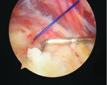 Fig. 2. Chalk-like calcific deposit in subacromial space was demonstrated.