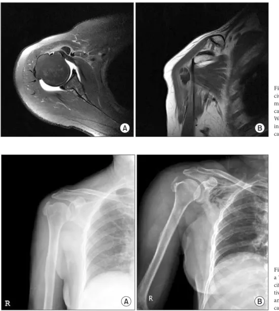 Fig. 3. (A) We measured gross mass of cal- cal-cium deposit in axial and coronal image of  magnetic resonance imaging (MRI), then was  calculated the average of the two value