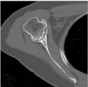 Fig. 1. Magnetic resonance imaging shows thinning of the rotator cuff in a 