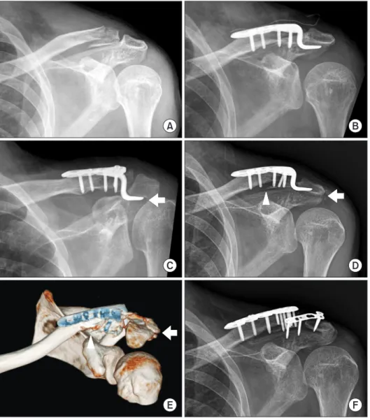 Fig. 2. (A) The initial radiography show- show-ing Neer type IIB fracture of lateral end of  clavicle
