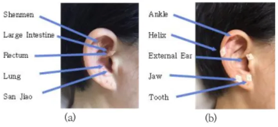 Fig.  1.  Acupoints  for  experimental  group  and  sham  control  group 