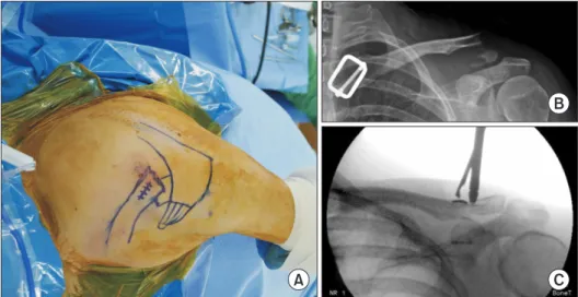 Fig. 1. Showing a reduction procedure under  C-arm guidance before final fixation using  the flip button device