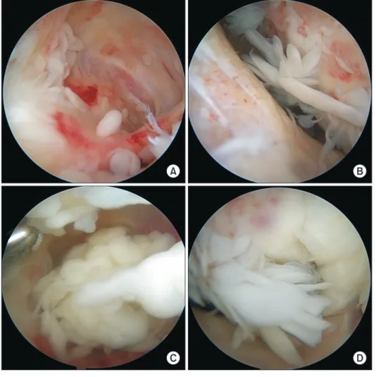 Fig. 2. Arthroscopy revealed bursitis (A) with  many loose bodies in various shapes and sizes  (B)
