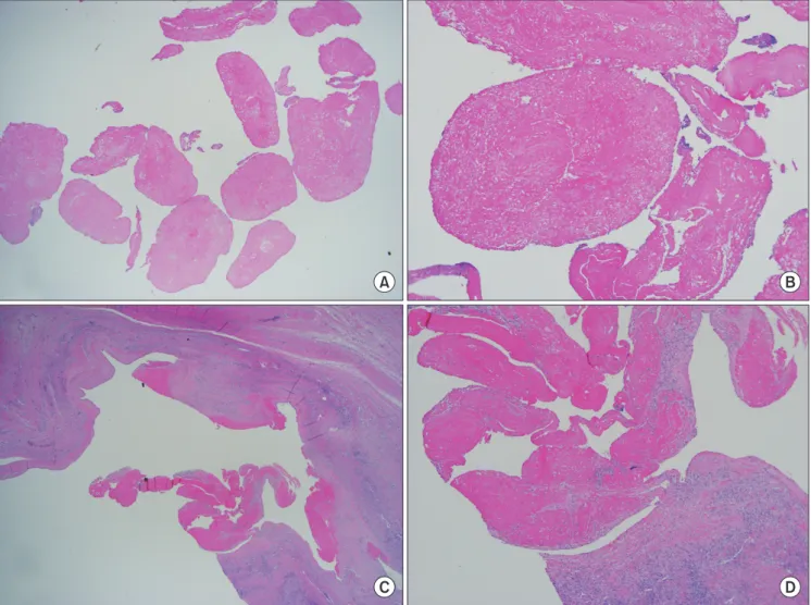 Fig. 4. Multiple loose nodules with fibrinous content consistent with the finding of rice bodies (A: ×1.25, B: ×40; H&amp;E)