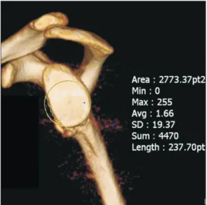Fig. 1. The method of glenoid defect size’s measurement.