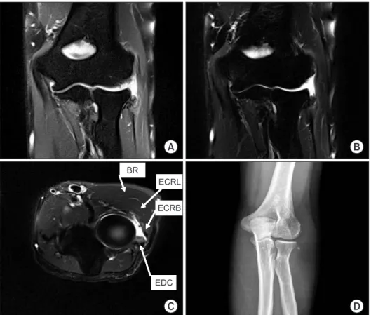 Fig. 1. (A, B) Common extensor tendon tear  was observed in a T2 coronary image. (C)  ECRB tendon tear was observed in a T2 axial  image