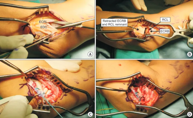 Fig. 2. (A) Detached ECRB tendon from the origin site between ECRL and EDC. (B) Retracted ECRB and torn RCL was observed aft er retraction of ECRL and  EDC
