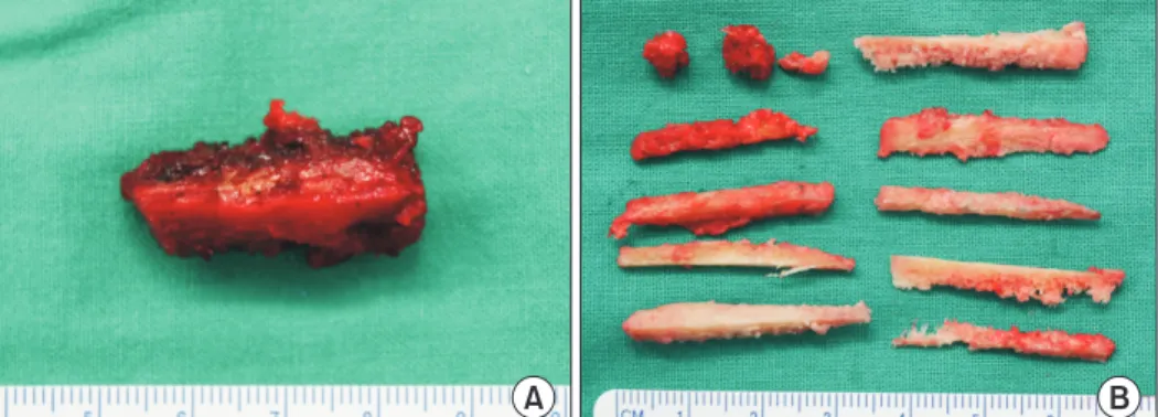 Fig. 4. Th   e sutures are tied with periosteum, fi rmly opposing the bone graft  to  the nonunion site.