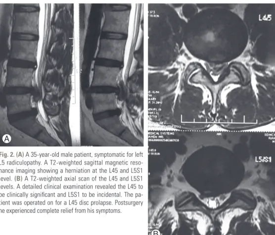 Fig. 2. (A) A 35 -year-old male patient, symptomatic for left  L5 radiculopathy. A T2 -weighted sagittal magnetic  reso-nance imaging showing a herniation at the L45 and L5S1  level