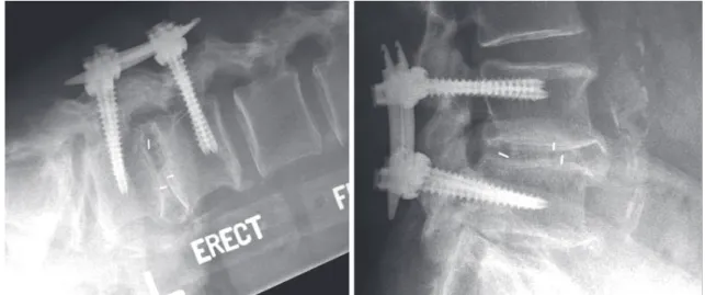 Fig. 2. Erect flexion/extension X-rays of a patient without bone morphogenic protein demonstrating Bridwell grade 1 fusion with  no movement