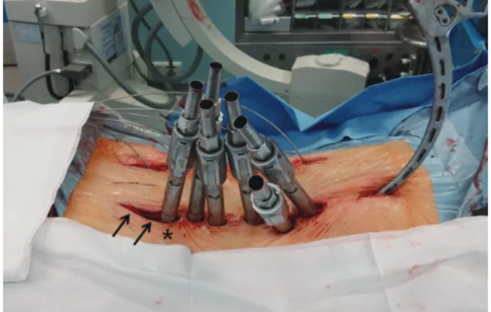 Fig. 3. The incision for the S1 screw ( *) was extended caudally for  insertion and assembly of the iliac screws (arrows).