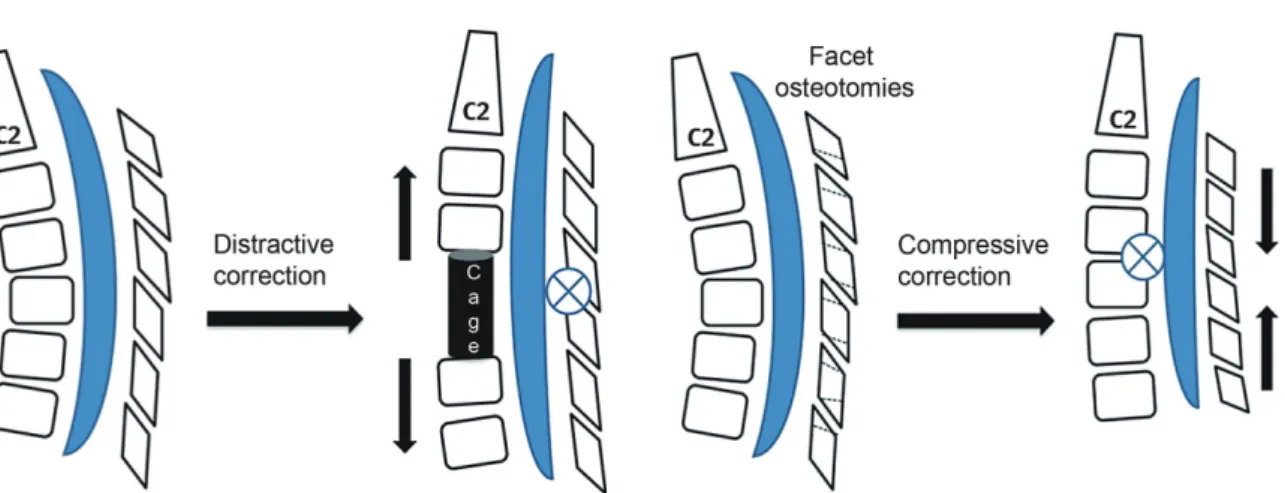 Fig. 1. The distractive correction of kyphosis achieved by anterior cage placement has a lengthening effect on the spinal cord as the  axis of rotational correction falls on the fixed facet joint complex