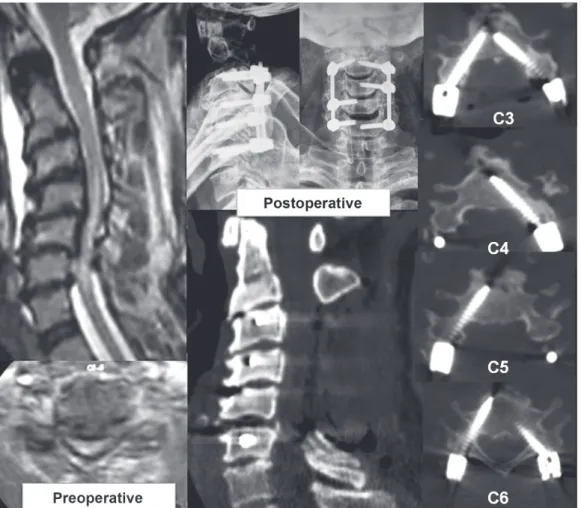 Fig. 7. Examinations of patient 1 reveals the preoperative kyphotic cervical stenosis with intra -medullary signal  changes on magnetic resonance imaging and postoperative X-ray and computed tomography scans