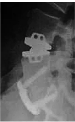 Fig. 7. A hybrid lumbar disc arthroplasty/approach  for lumbar interbody fusion construct performed for  treatment of two-level disc disease in a 46-year-old  female.
