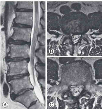 Fig. 3. Discography (A, B) and disco- computed tomography (CT) (C). 