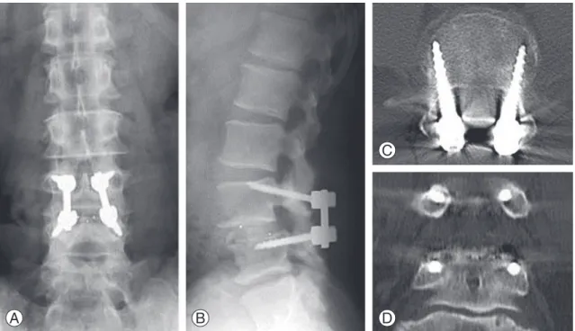 Fig. 1. Radiographs and multiplanar reconstruction computed tomography of the lumbar spine at 6 months after surgery in a  56 -year-old man who underwent less-invasive posterior lumbar interbody fusion with our cortical bone trajectory screw fixation  for 