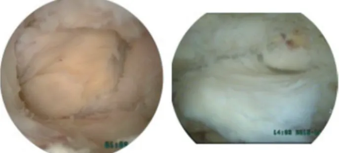 Fig. 6. Approach views from the left side. (A) An ipsilateral view on  the left side after removing the outer layer of ligamentum flavum and  laminectomy with a high -speed burr